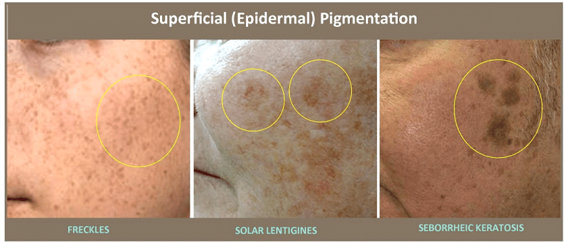 Before & After image of Skin Pigmentation Treatment Plano TX